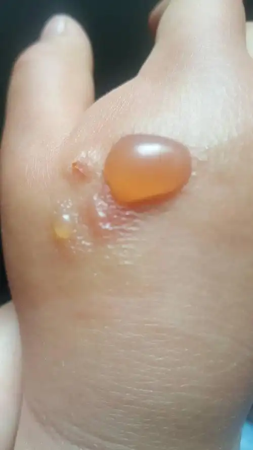 儿童不知道让什么咬到出的大水泡,以前让蚊子咬过也是出过这种大水泡