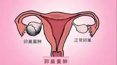 孕期遇上卵巢囊肿破裂专家孕12周前不建议对卵巢动刀