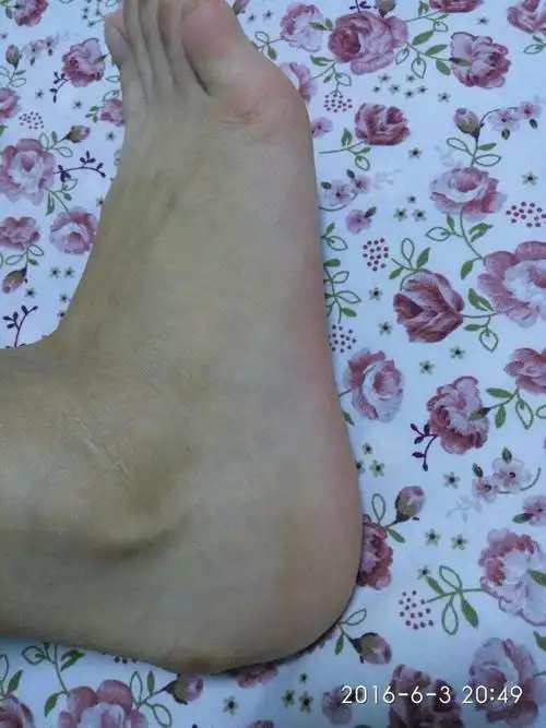 后脚跟的骨头突出一块穿鞋有时候磨脚.平时不疼不痒的.