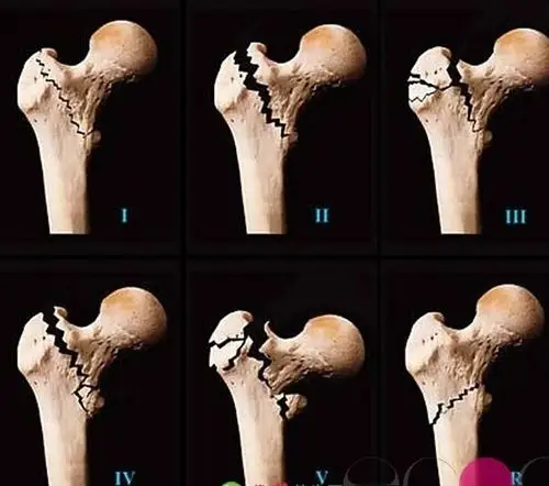 股骨头坏死三期的图片