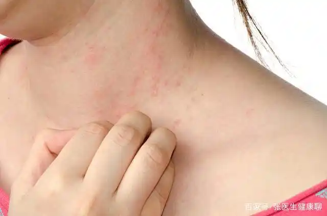 导语:汗疱症(pompholyx)也称为止汗湿疹和疱疹,是一种水疱性皮肤病,在