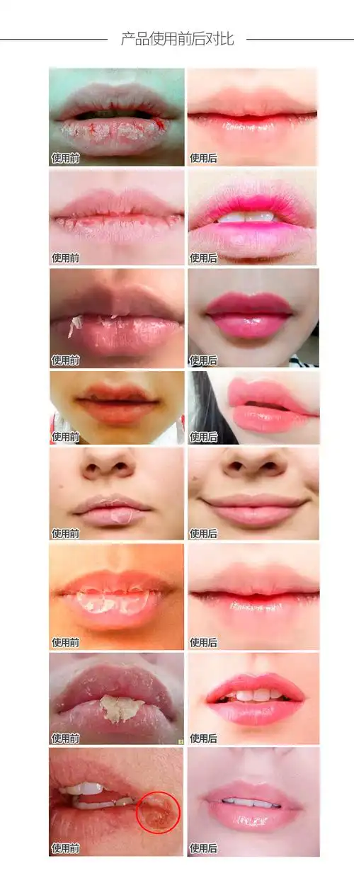 三支装唇膏专用药口唇修复润唇膏可用嘴唇防干裂烂嘴角脱皮叶子草40g