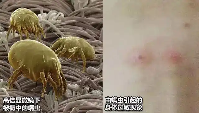 对付螨虫除螨仪到底该不该买