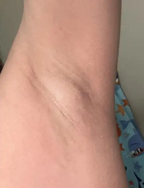 淋巴结肿大:大多是暂时的也不要手痒去挤它