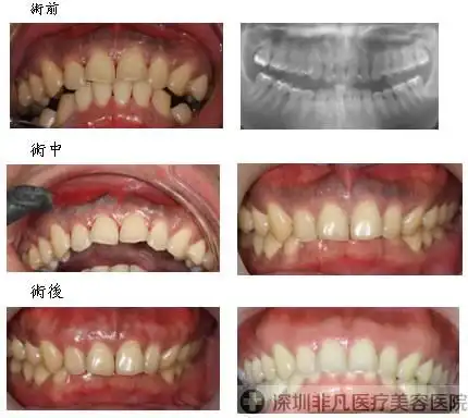 牙龈切除术前术后效果对比图