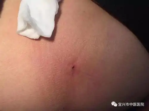 一女子在团氿湿地公园跑步,蜱虫钻进皮肤,竟浑然不知!