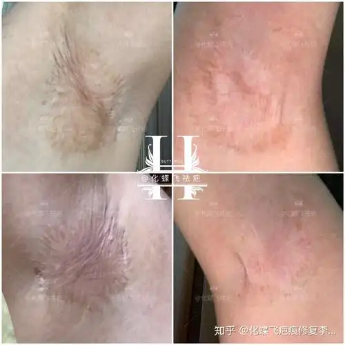 15年的腋下手术疤痕中药代谢两次恢复了至少70