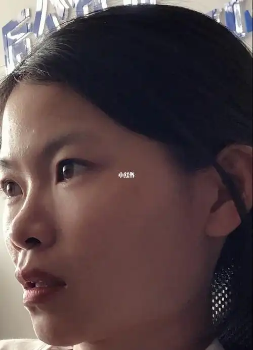 救命凸嘴和法令纹都是鼻基底凹陷导致吗