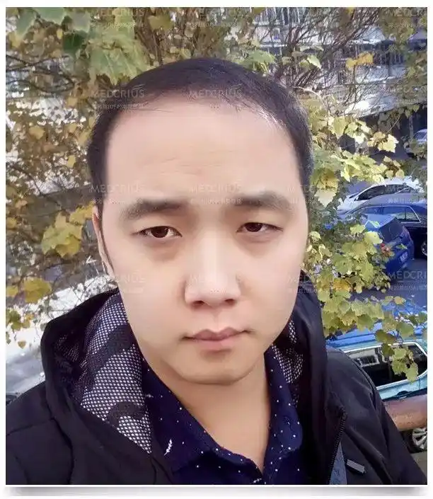 "90后秃顶大叔"战胜脱发后意外走红!网友:脱发还能这么治?