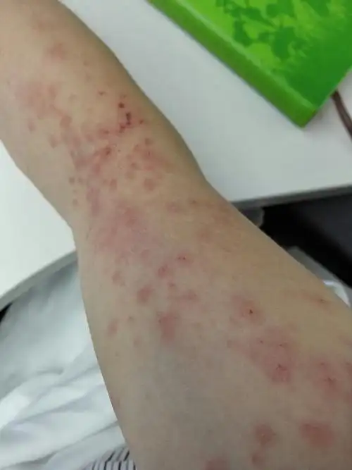 手臂突然长了一片红点,很痒.是被什么咬的还是体质原因.