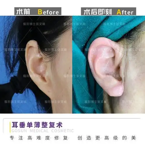 丰耳垂术助你拥有饱满丰盈的耳垂
