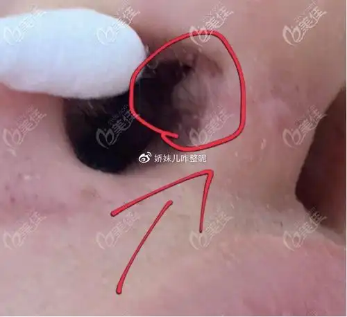 硅胶隆鼻后假体漏出