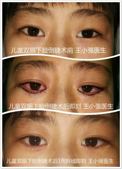 倒睫与睑内翻矫正的常见问答附手术图片