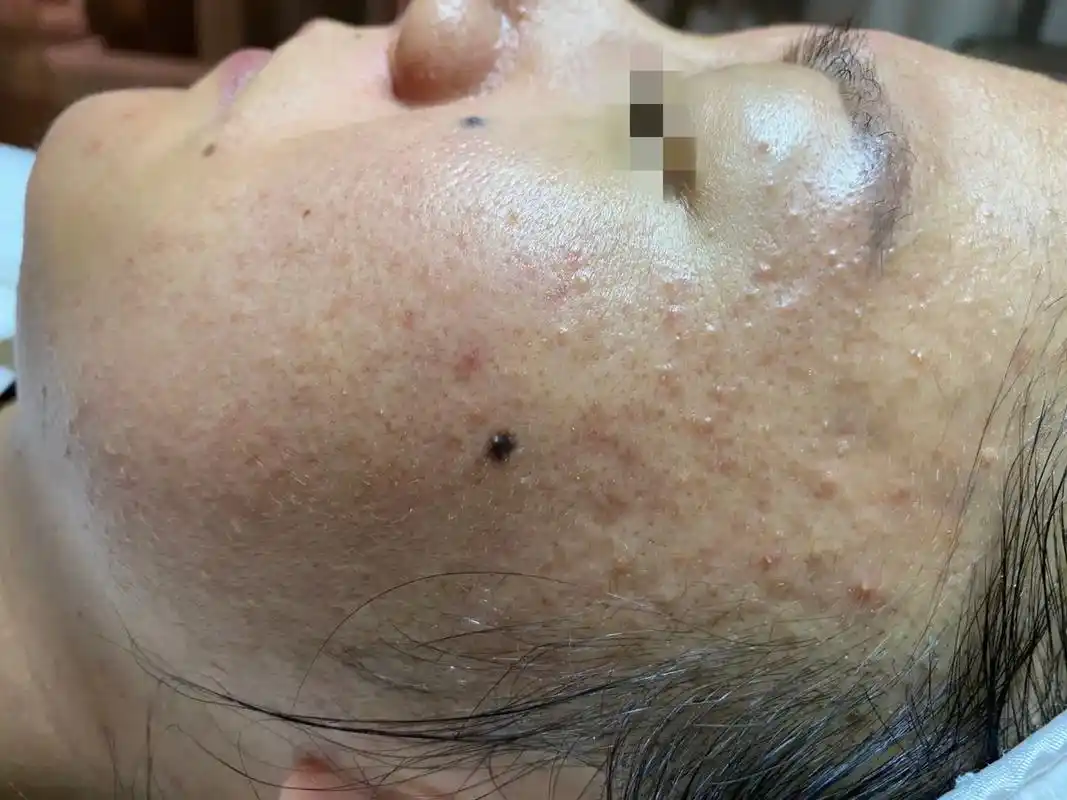 添美颜本草纯中药面膜改良皮肤的基底层通过表皮渗透治标治本