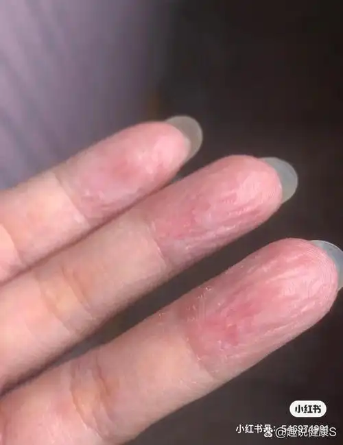 手一碰水就皱-水源性端角化症 19年夏天得过这个病,今年也是夏天出现