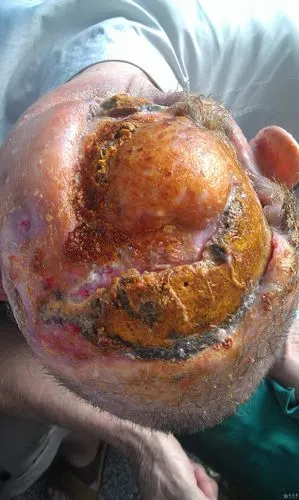 求治疗方案——全国首例基底细胞癌