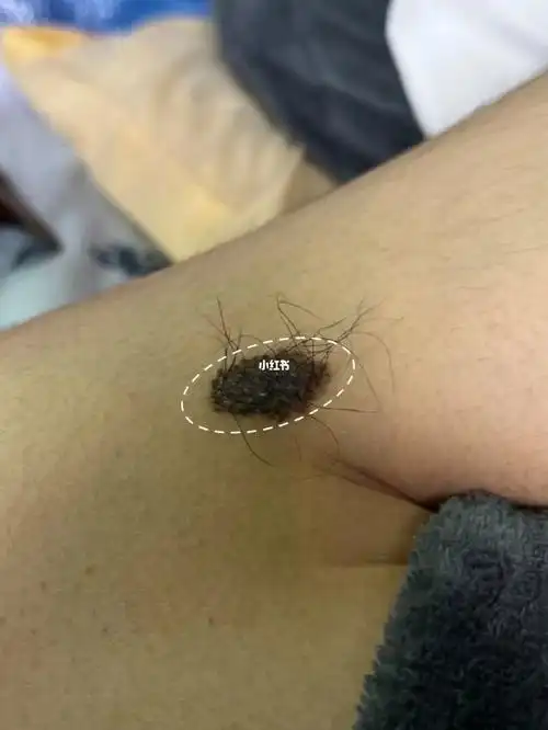 有了它,去黑毛痣只需要21天!