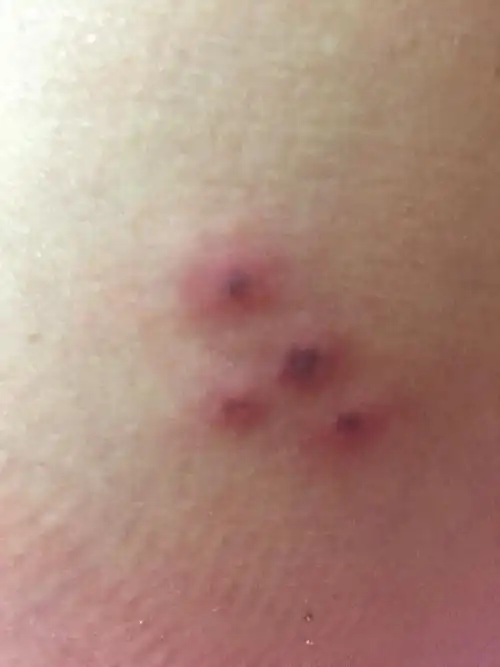 腰部一星期了,痒.谁知道这是什么情况?是虫子咬的还是长得?