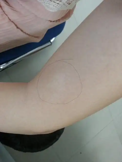 手臂上不知道是怎么回事,有几块地方有这样白色的皮肤,大家知道是怎么