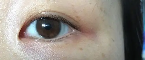 想问一下眼角的这种斑能去吗.慎入