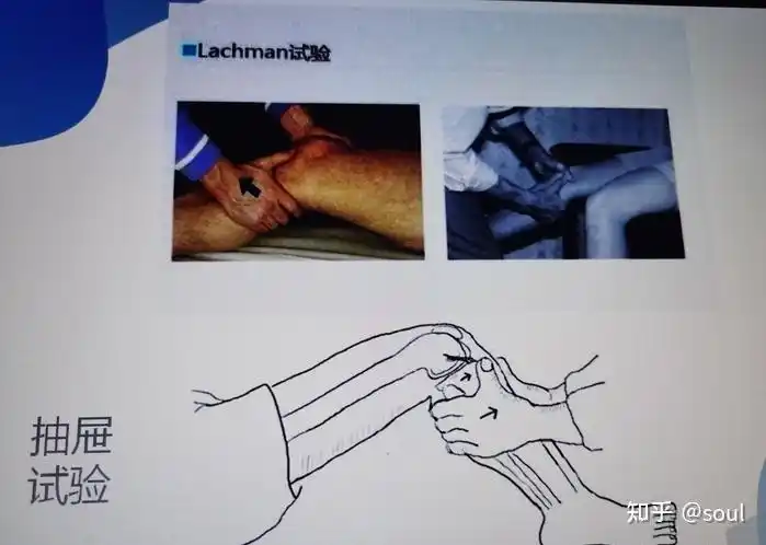 对于前后交叉韧带的损伤,可以通过抽屉试验来进行检查