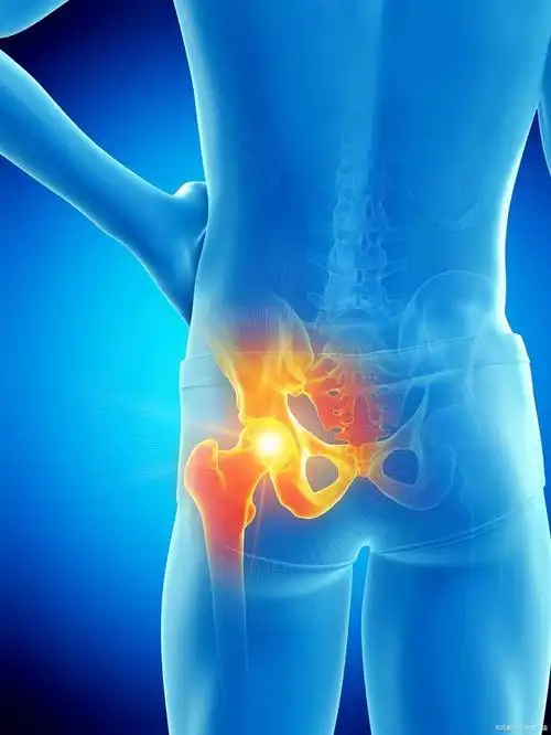 胯骨老是疼痛,你知道怎么回事吗?有可能是这4种疾病引起的