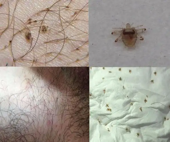 去虱子除阴虱私处虱卵药成人男士用儿童喷雾洗液阴虱净喷剂奇痒阴