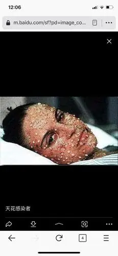 入组第一帖,有木有去搜索过感染天花后的样子【慎.