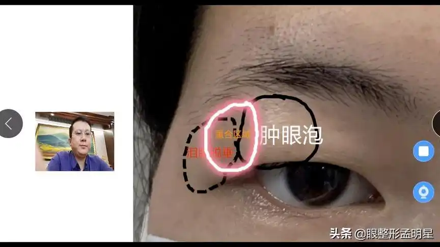 如何去鉴别泪腺脱垂看完这张图就可以自我鉴别