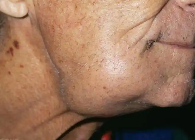 淋巴结肿大是淋巴瘤的首发症状,淋巴瘤的发病率很低,是淋巴组织恶性