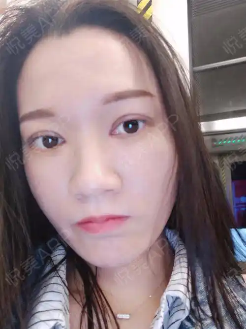 上睑下垂矫正术后7天_眼综合整形术后7天_开外眼角术后7天_全切双眼皮