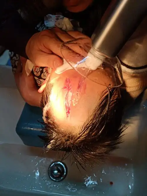 这是头部的伤口