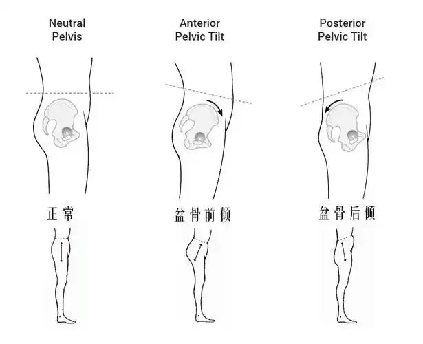 盆骨前倾
