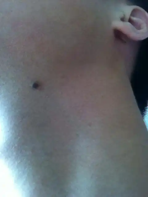 这个痣有恶化的危险么?它会长毛