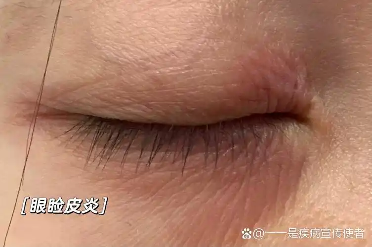 眼睛褶皱,红肿,起皮,疼痛