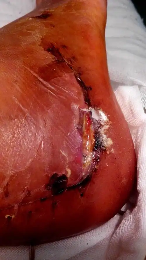 跟骨粉碎性骨折做了手术一个月了但是有三针伤口就是长不住怎么回事?