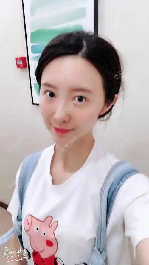 angel姐的真皮隆鼻日记