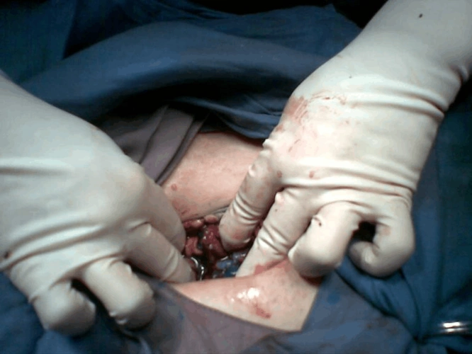 我院妇产科成功开展输卵管复通术