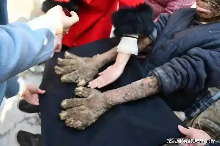 巨野县发现一极罕见病人手脚长满厚厚甲壳医学专家称属亚洲第一例