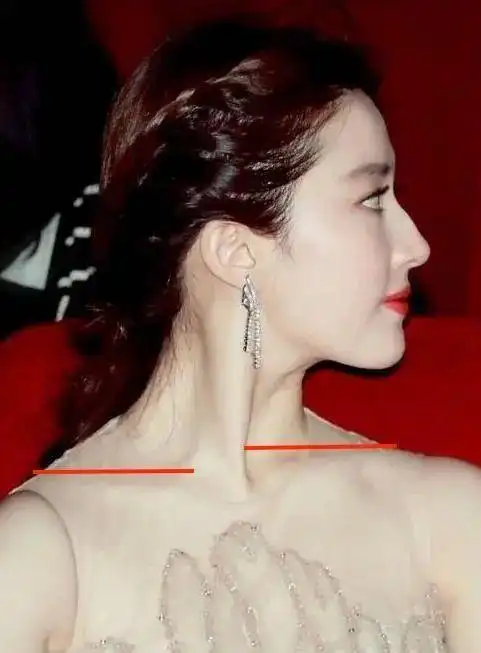 特征二:锁骨高低不同除了这种,高低肩还会呈现出另一种样子.