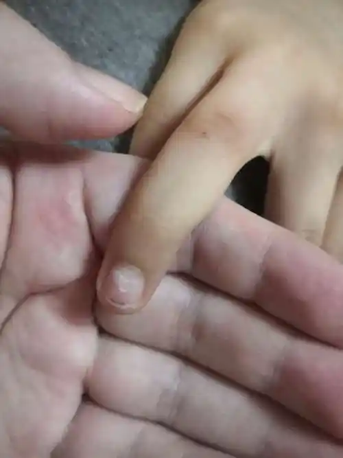 您好我想问一下孩子指甲发白粉白有点粉会不会是贫血