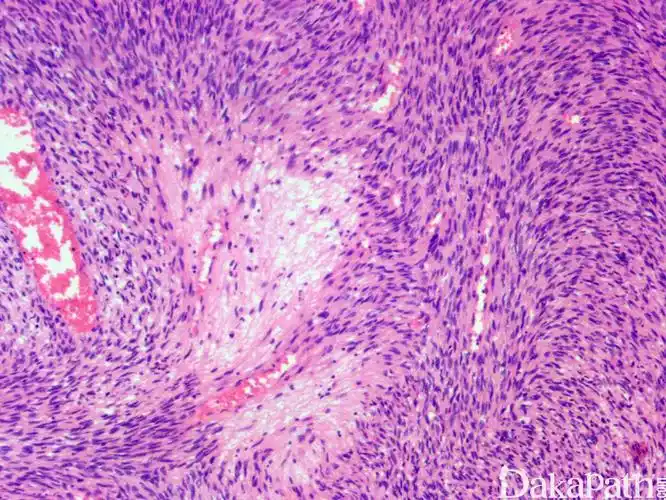 隆突性皮肤纤维肉瘤