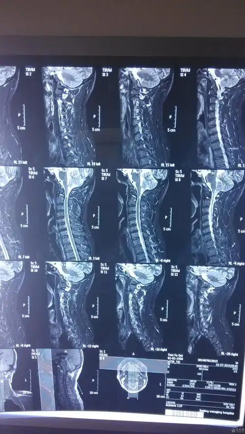 请大神们看个颈椎病的片子