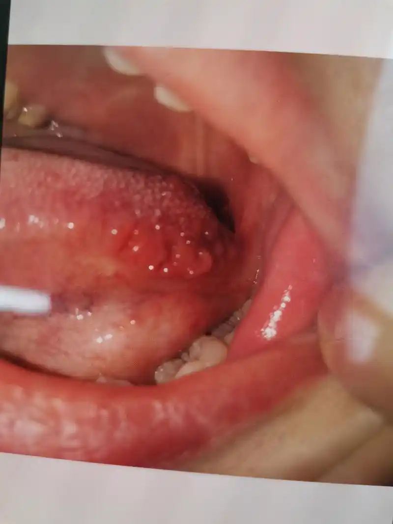 两边舌头两侧有这种小疙瘩,没有不适感,有没有知道什么情况的