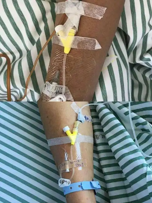 留置针y型接口朝内