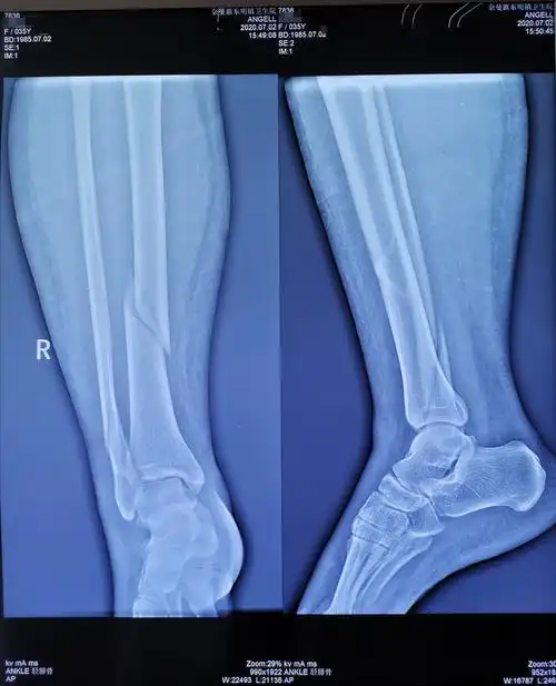 胫腓骨下段骨折闭合复位髓内钉内固定加腓骨下段锁定钢板内固定手术一