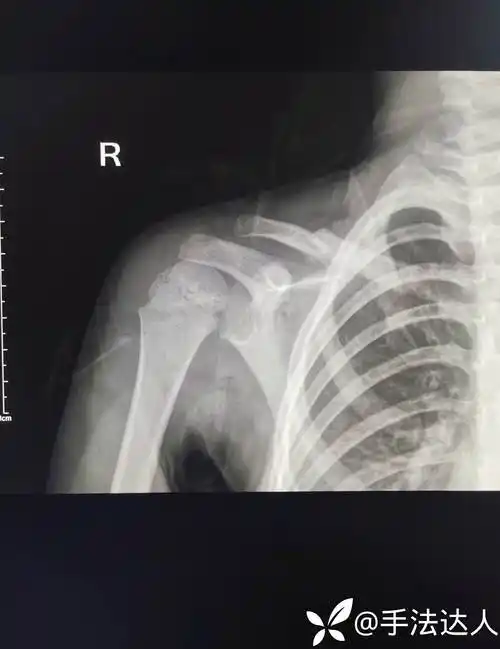 女3岁11月外伤后锁骨骨折三周八字锁骨带固定中似有错位需要怎么