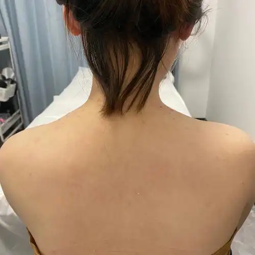 打瘦肩针第八天