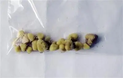 日灌10瓶啤酒「溶化」结石 重庆男子肾结石长到2.5公分