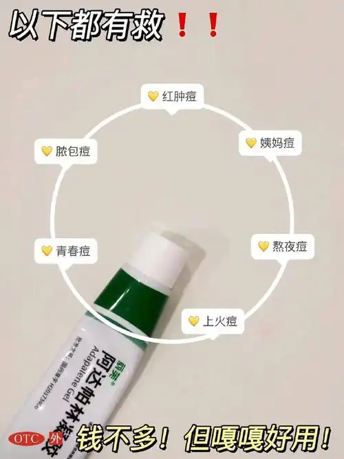 阿达帕林##阿达帕林凝胶##丽芙阿达帕林凝胶##阿达帕